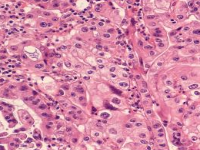 格拉斯哥大学 | 正在进行改变游戏规则的新胰腺癌治疗研究