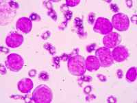 阿德莱德大学 | 新的治疗方法可以帮助慢性粒细胞白血病患者无药生存